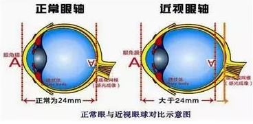 近視眼球突出？！控制近視度數(shù)加深是關(guān)鍵！