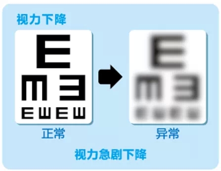 視網(wǎng)膜脫離啥癥狀？這張圖告訴你！