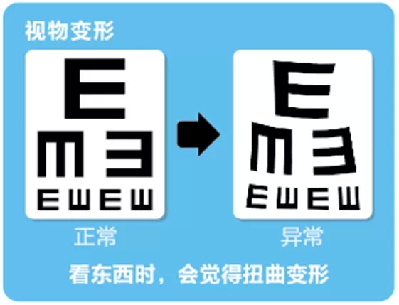 視網(wǎng)膜脫離啥癥狀？這張圖告訴你！