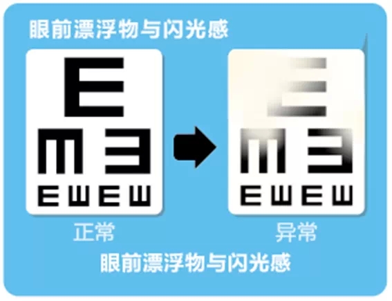 視網(wǎng)膜脫離啥癥狀？這張圖告訴你！