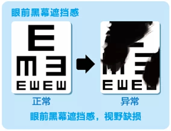視網(wǎng)膜脫離啥癥狀？這張圖告訴你！