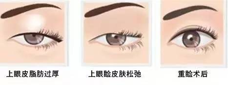 為什么要做雙眼皮？5個(gè)理由說服你！