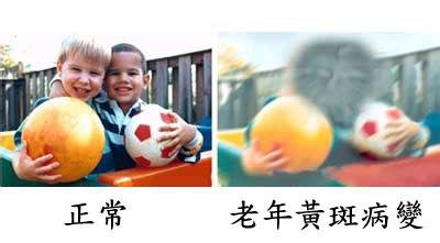 黃斑變性與老花眼，兩者不一樣！