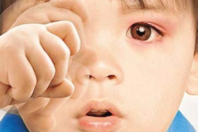 秋季紅眼病高發(fā)，當心孩子被傳染
