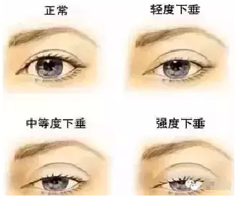 “美目貼”別依賴，小心眼皮下垂