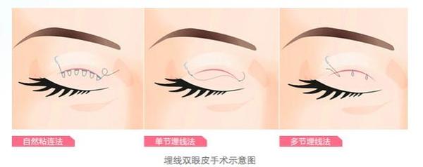 眼整形的恢復(fù)期是多長？你肯定想知道！
