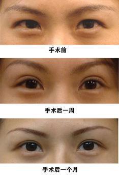 眼整形的恢復(fù)期是多長？你肯定想知道！