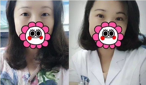 要不要做雙眼皮？別糾結(jié)了看這個(gè)！