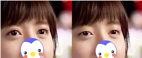 要不要做雙眼皮？別糾結(jié)了看這個(gè)！