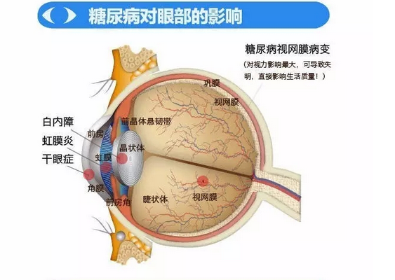 你造嗎？糖尿病晚期眼睛會致盲！