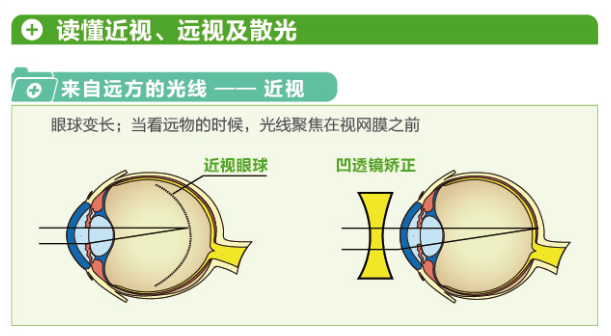 【看圖解】一張圖教你看懂近視、遠(yuǎn)視和散光