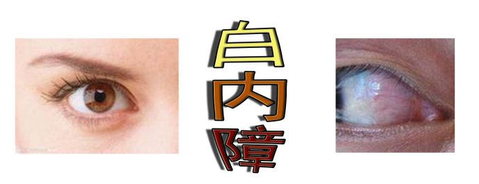白內障手術會反復嗎？