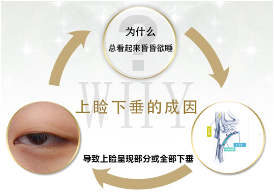 拯救惺忪睡眼，告別上瞼下垂！