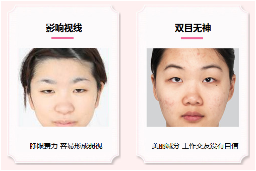 拯救惺忪睡眼，告別上瞼下垂！