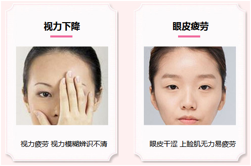拯救惺忪睡眼，告別上瞼下垂！