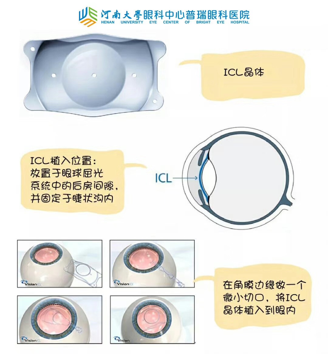 近視度數(shù)太高，還能做手術(shù)嗎？