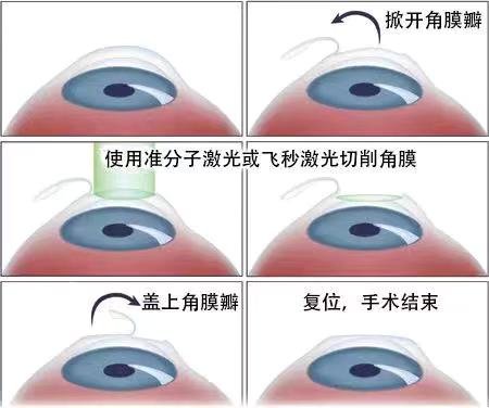 如果眼睛近視了該怎么？
