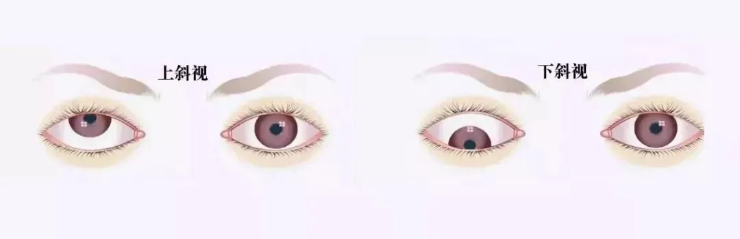關(guān)于斜視，這幾個(gè)誤區(qū)害人不淺!