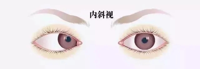 關(guān)于斜視，這幾個(gè)誤區(qū)害人不淺!