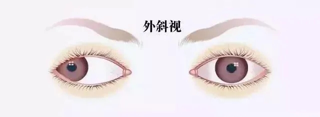 關(guān)于斜視，這幾個(gè)誤區(qū)害人不淺!