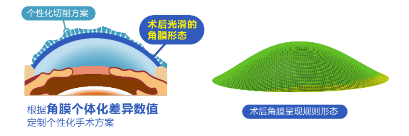 微雕優(yōu)視飛秒，重新定義角膜屈光手術(shù)，讓視力多看一行！