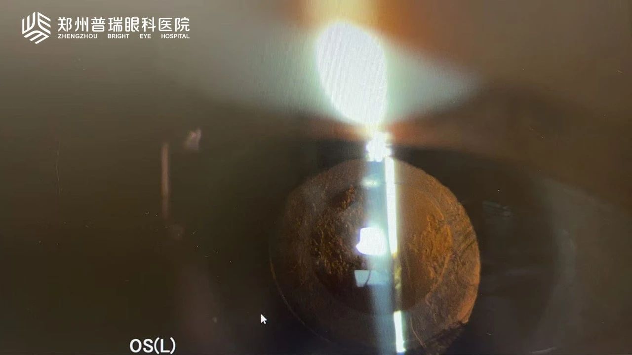 白內(nèi)障術(shù)后視力又下降？6大原因多方面解析！